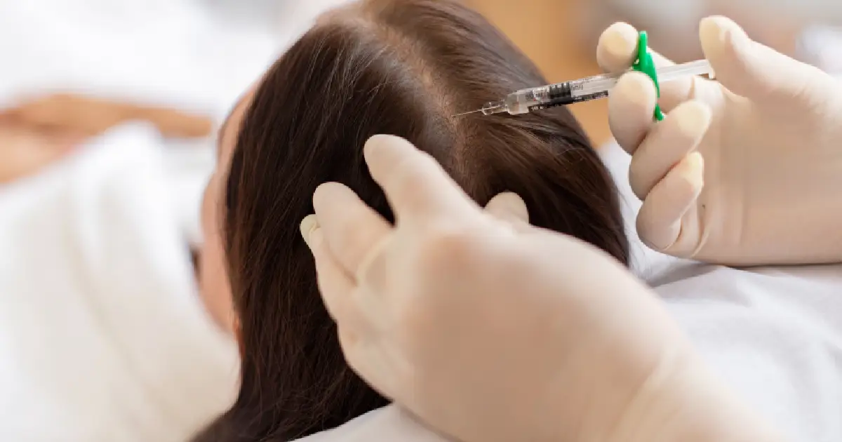 Top 5 Benefits of Alma TED for Effective Hair Restoration